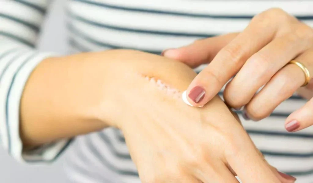 Make the uncalled Burns go away the Right Way!